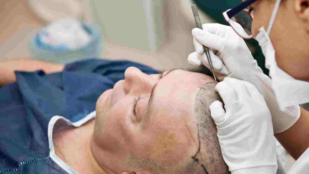 Top 10 Benefits of Surgical Hair Transplantation at New Look Clinic, Bangalore