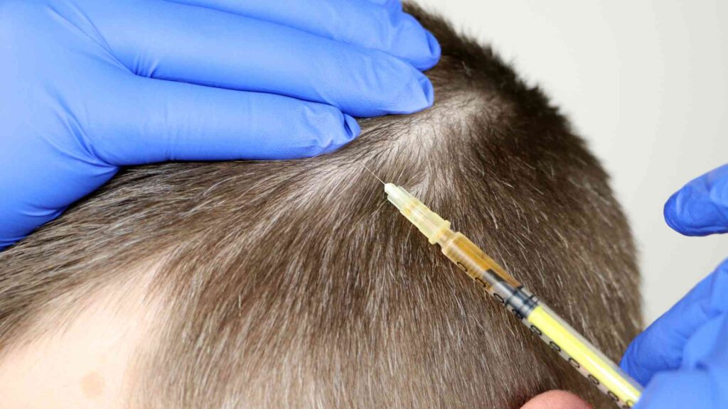 Erasing Bald Patches with Non-Surgical PRP Advanced Hair Re-GrowthTreatment
