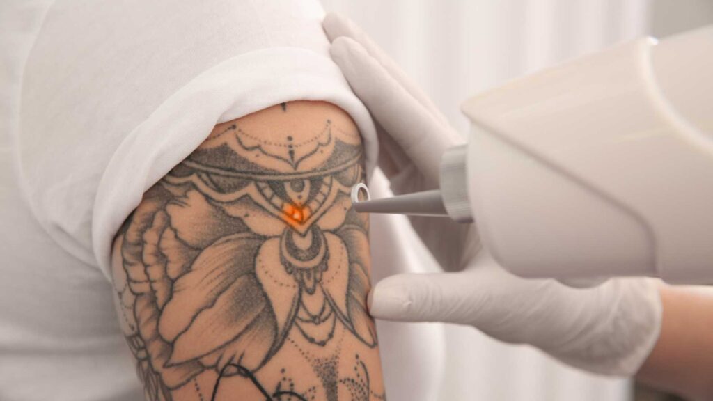 Your Journey to Ink-Free Skin: What to Expect Before, During, and After Tattoo Removal at New Look Clinic, Indranagar, Bangalore