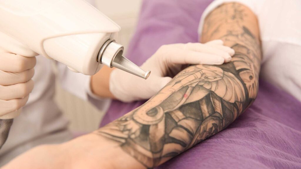 Say Goodbye to Tattoo Regrets: Top Reasons People Choose Tattoo Removal in Bangalore