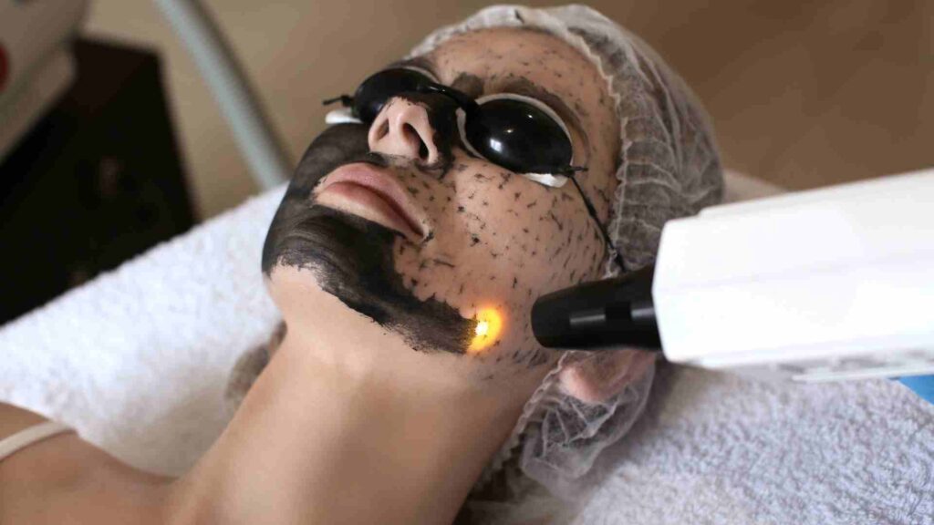 Banish Imperfections: Carbon Peel Laser for Acne, Scarring and Pigmentation Solution at New Look Clinic