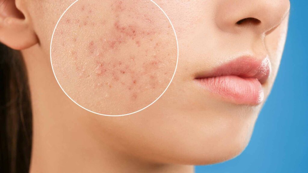 The Ultimate Guide to Combat Acne: Expert Recommendations from Dermatologists and Cosmetologists