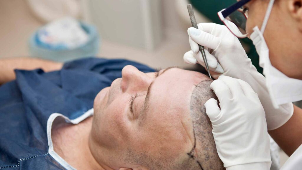 Revolutionizing Hair Restoration: Surgical Hair Treatments at New Look Clinic